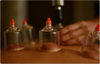 Myofascial vacuum cupping(copy)